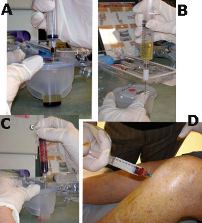 PRP PREP AND INJECTION