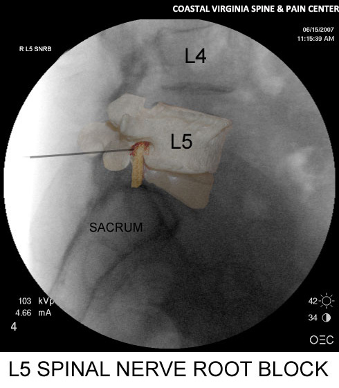 Selective-nerver-root-block